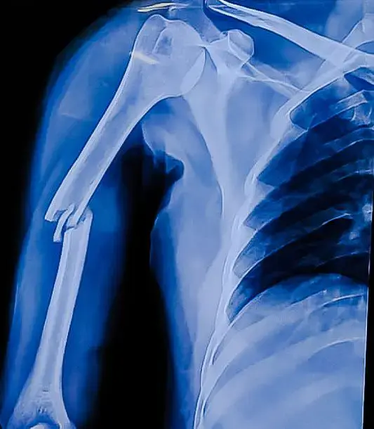 Fracture and Dislocation