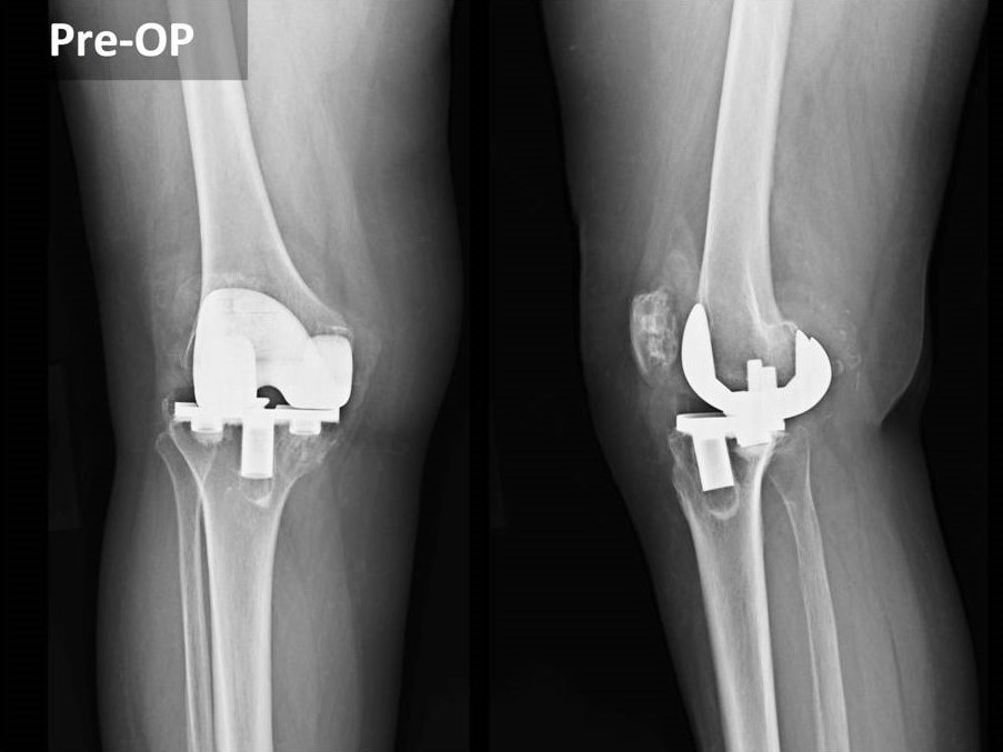 Joint Replacement
