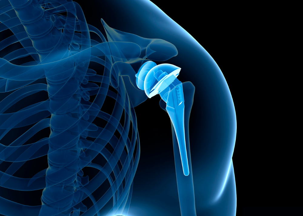 Joint Replacement